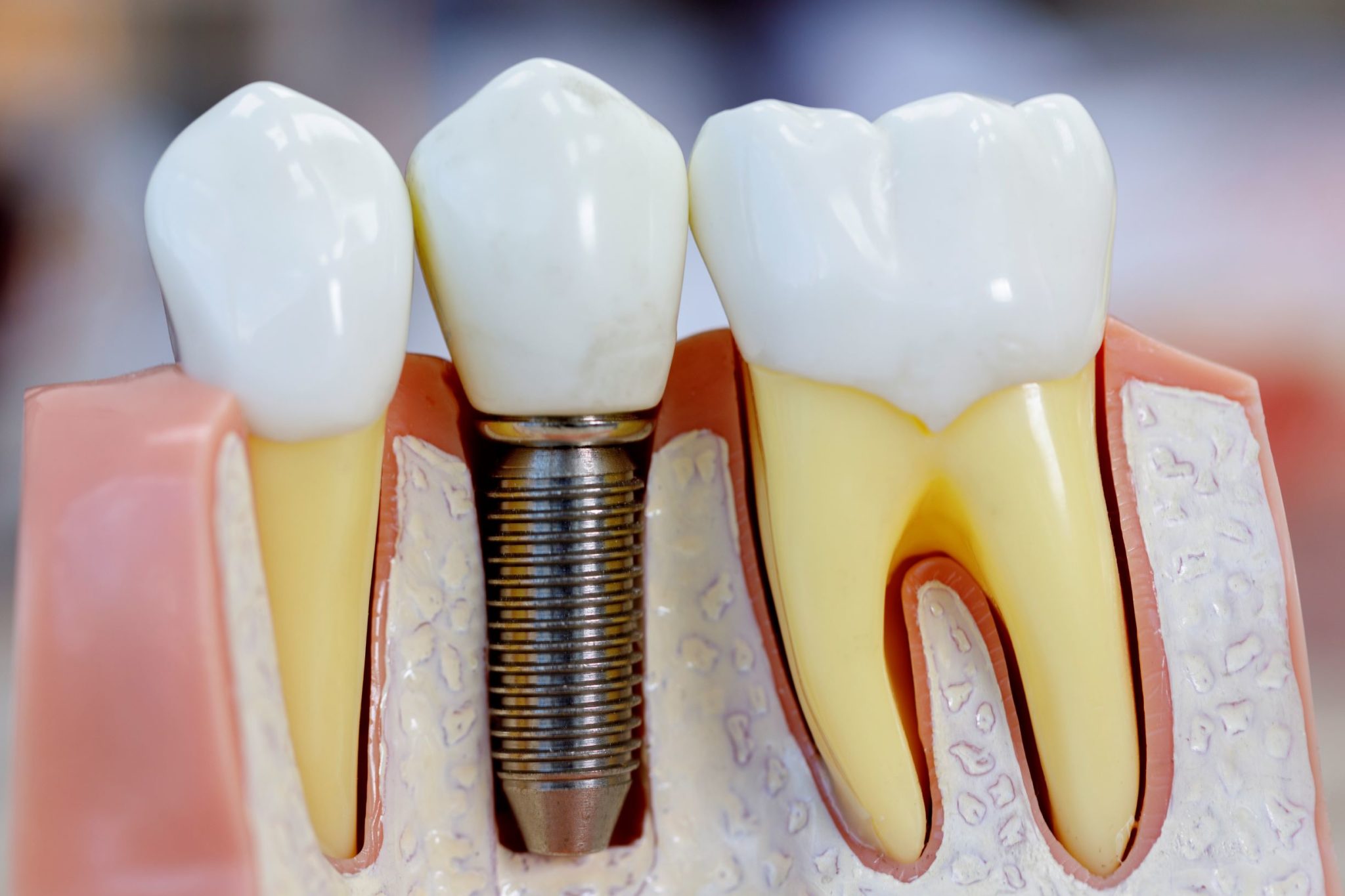 Fienman-_-Blog-Dental-Implants-inner-image-960752450-2048x1365