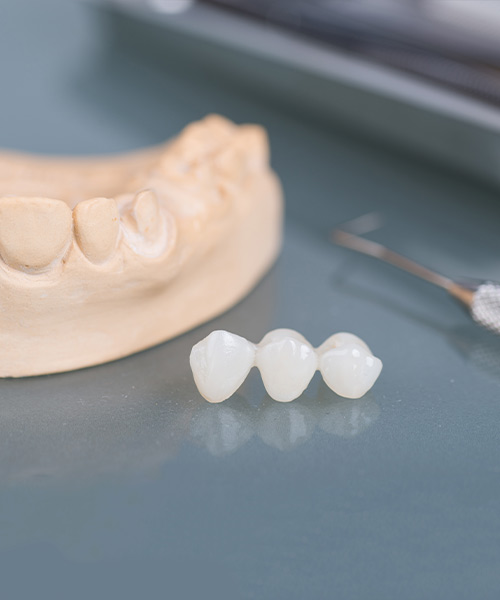 Our West Bloomfield, Michigan dentist can use porcelain fixed bridges to replace missing teeth.