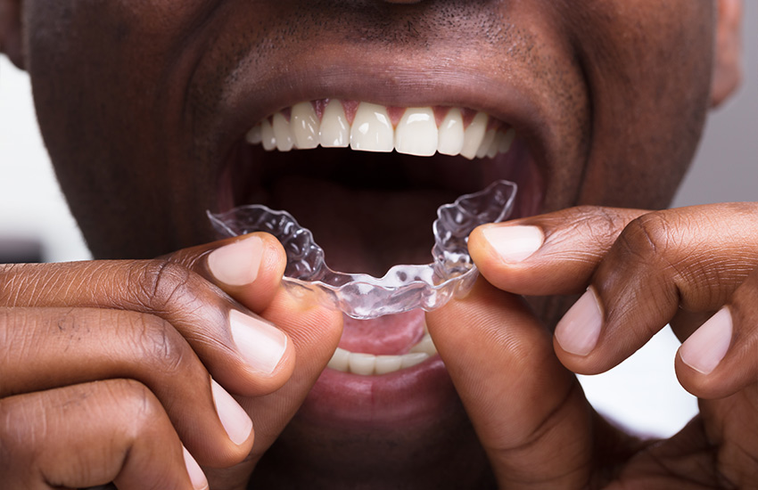 How Invisalign Works: Is It the Solution for You?