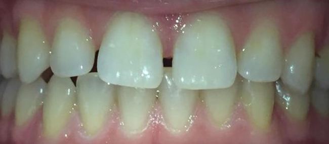 Closeup of front teeth before cosmetic surgery in our West Bloomfield, Michigan dental office