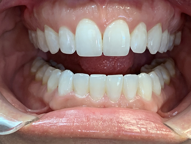 Closeup image of a patient's open smile after a dental procedure