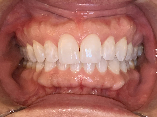 Closeup image of a patient's teeth after a dental procedure