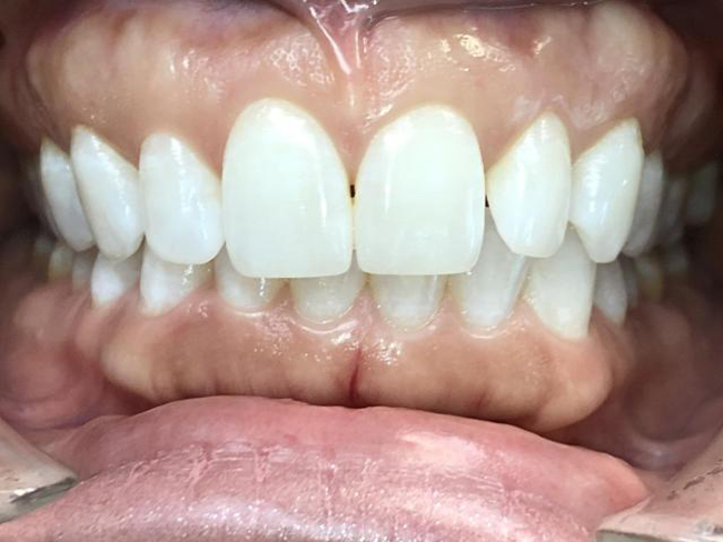 Closeup image of a patient's teeth before a dental procedure