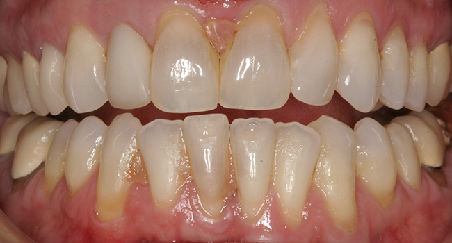 Closeup image of a patient's open smile before a restorative dental procedure