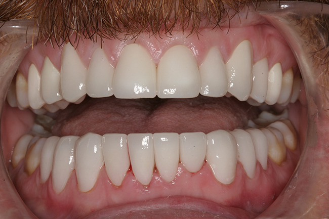 Closeup image of a patient's open smile after dental restoration