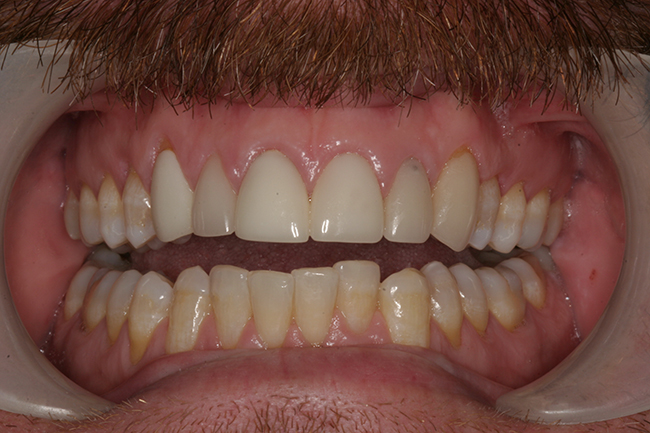Closeup image of a patient's open smile before a procedure