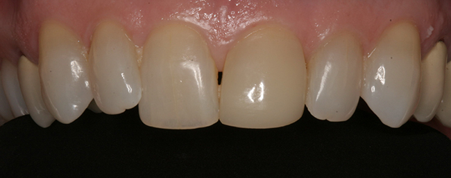 The chipped tooth is repaired, as shown in this closeup.