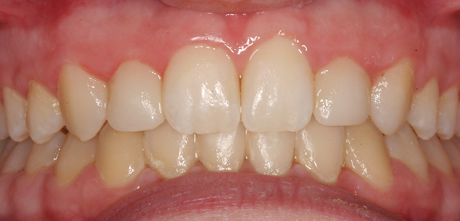 Small laterals after cosmetic tooth treatment