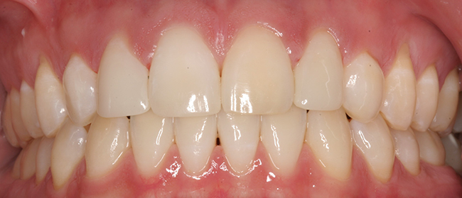 Small laterals after dental surgery