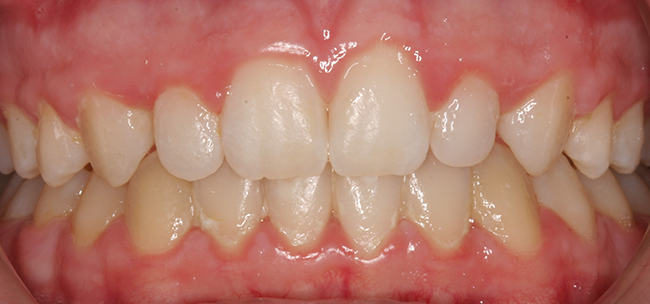 Small laterals before cosmetic tooth treatment