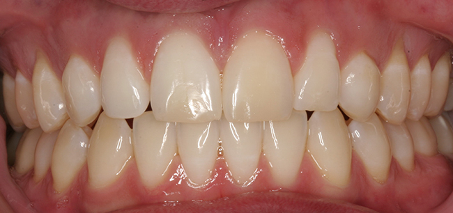 Smaller laterals before dental surgery