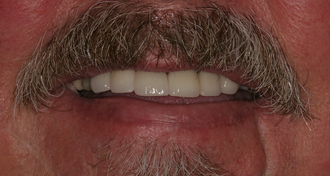 Closeup image of a patient's teeth, which had been discolored and crooked, after the dental procedure
