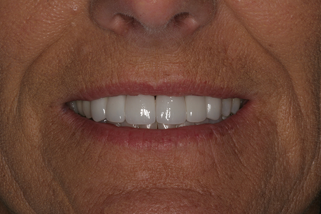 Closeup image of a patient's teeth after a cosmetic dental procedure