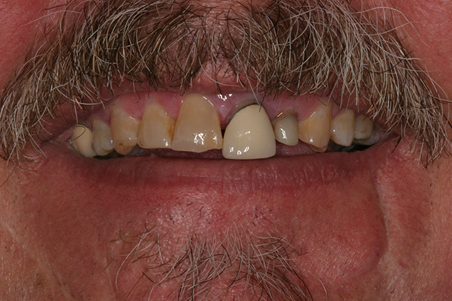Closeup image of a patient's discolored and crooked teeth before a dental procedure