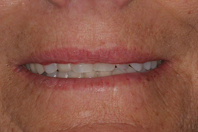 Closeup image of a patient's small teeth before a cosmetic dental procedure