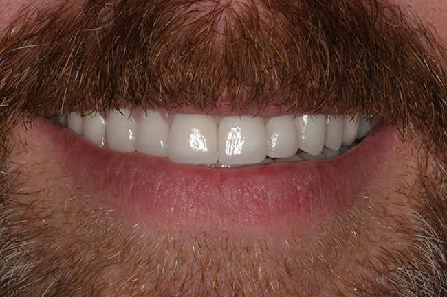 Closeup image of a patient's smile after a cosmetic dental procedure