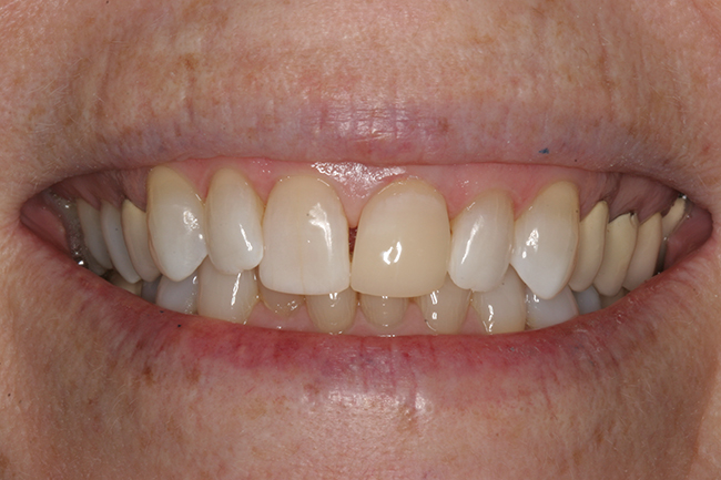 A smile after tooth whitening treatment