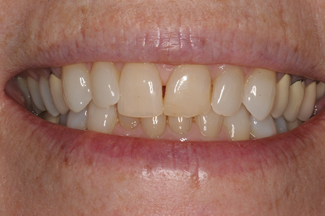 A smile before tooth whitening treatment