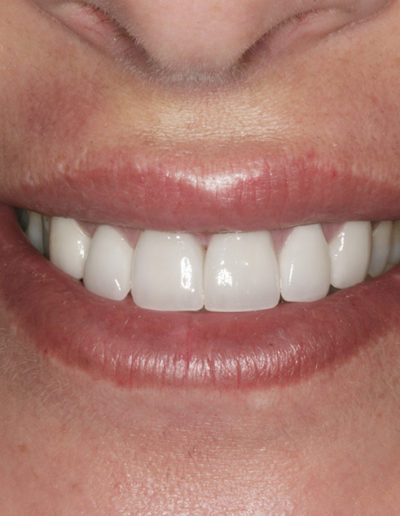 Closeup image of a patient's smile after an anterior crown procedure