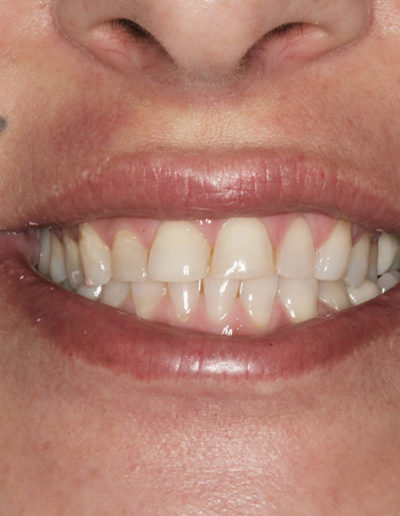 Closeup image of a patient's smile before anterior crown procedure