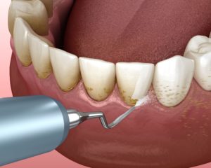Deep cleaning clears debris out from under your gums.