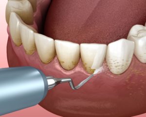 Regular Dental Cleaning vs Deep Cleaning: What is the Difference?