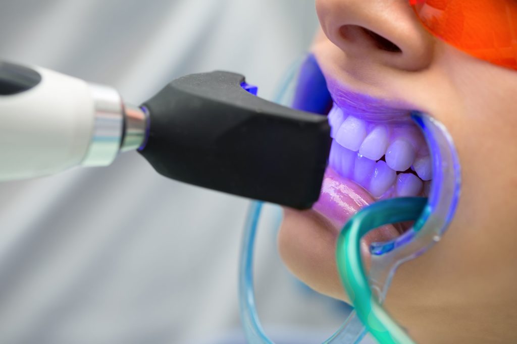 As shown here, during professional tooth whitening, a retractor may be used to keep your cheeks, tongue, and lips away from the peroxide solution. A curing light may also be used to activate the solution.