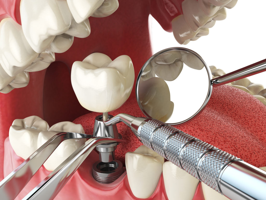 A dental implant procedure is depicted in this graphic.