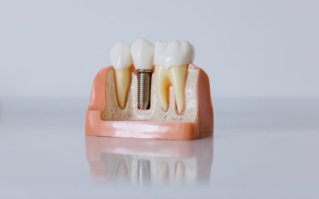 8 Benefits of Dental Implants