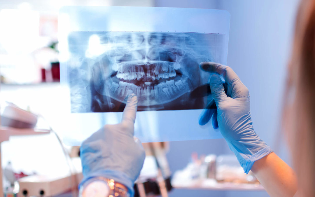 Dental X-Rays: Why the Benefits Outweigh the Risks