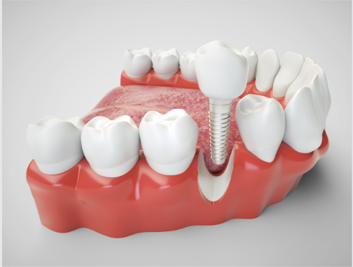 Considering Dental Implants Q & A 