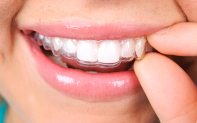 Why More Metro Detroit Adults Are Choosing Invisalign Over Traditional Braces