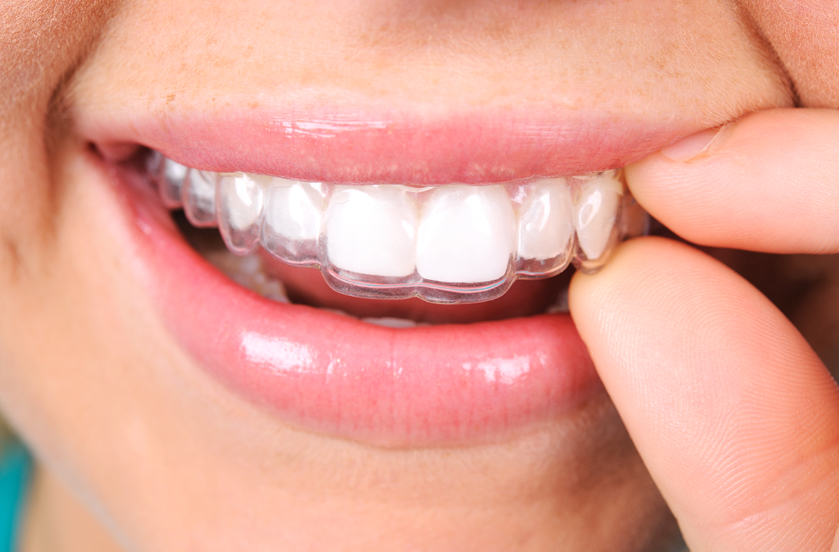 Smiling adult putting in Invisalign trays and aligner case, we also offer bioclear and porcelain veneers in west bloomfield