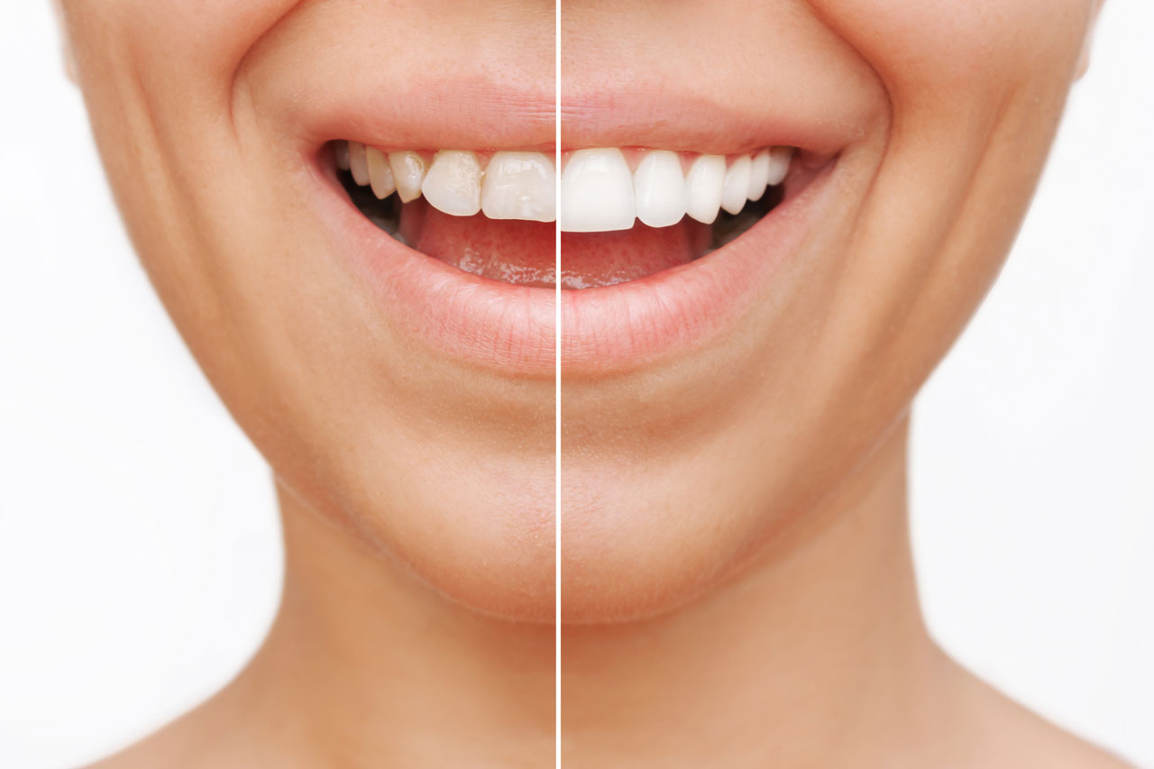Smile before and after Bioclear procedure