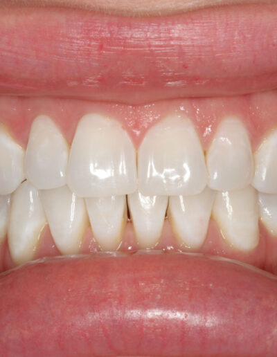 Before Bioclear Treatment