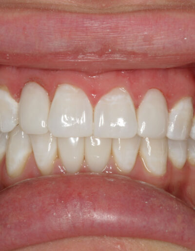 After Bioclear Treatment