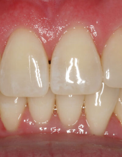 After Bioclear Treatment