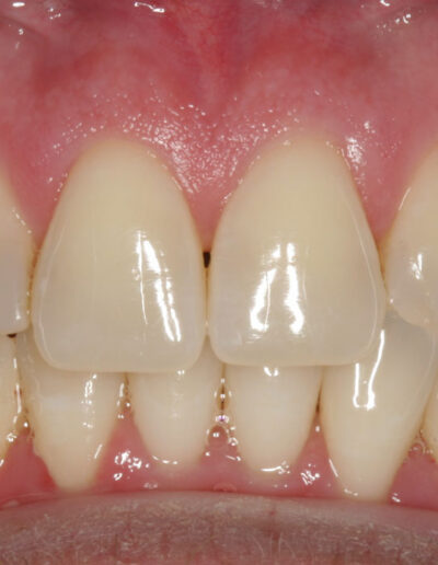 Before Bioclear Treatment